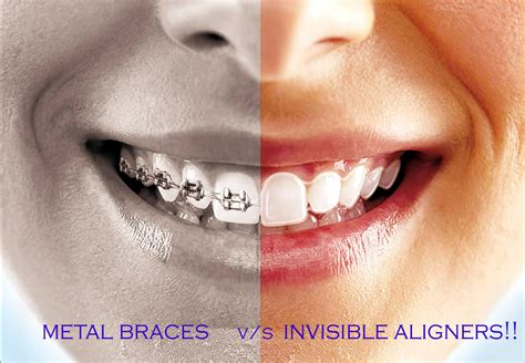 clear brackets vs metal brackets|clear aligners vs braces.